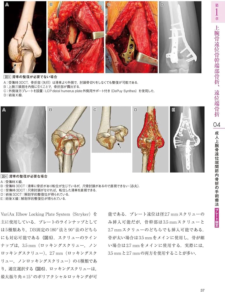 Amazon.co.jp: 肘の外傷:診断・手術・保存療法 (整形外科SURGICAL