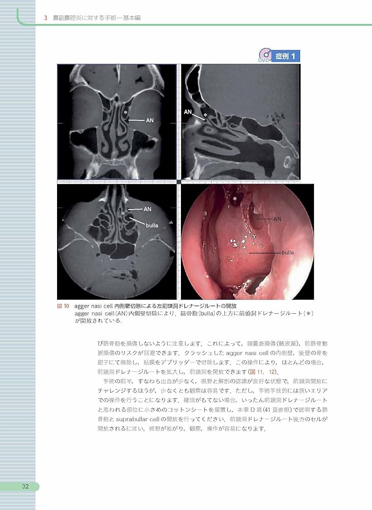 内視鏡下鼻副鼻腔・頭蓋底手術 [3DCT画像データDVD-ROM付]: CT読影と
