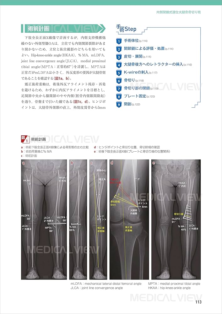 膝関節の再建手術 (新OS NEXUS No.1) | 松田 秀一 |本 | 通販 | Amazon