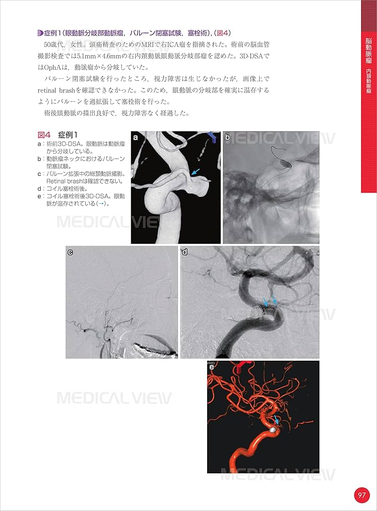脳血管内治療 スタート&スタンダード | 吉村 紳一 |本 | 通販 | Amazon