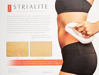Amazon.co.jp: Strialite The Stretch Mark Solution : DIY・工具