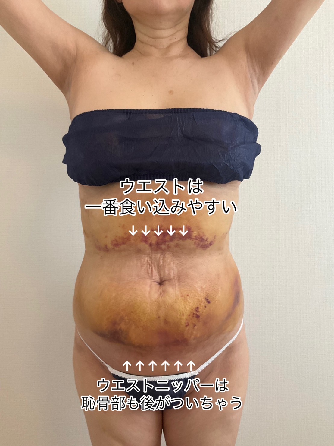 腹部の脂肪吸引ダウンタイム気を付けてほしいこと！ - 脂肪吸引後の