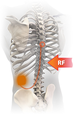 脊髄刺激療法とMRI（患者様とそのご家族へ）慢性疼痛用条件付きMRI対応