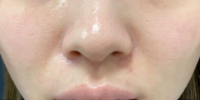 若いのにほうれい線が目立つ原因と即効性のある治療法 - NARU Beauty