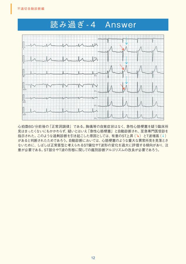 臨床心電図解析の実際 ― 不適切自動診断編