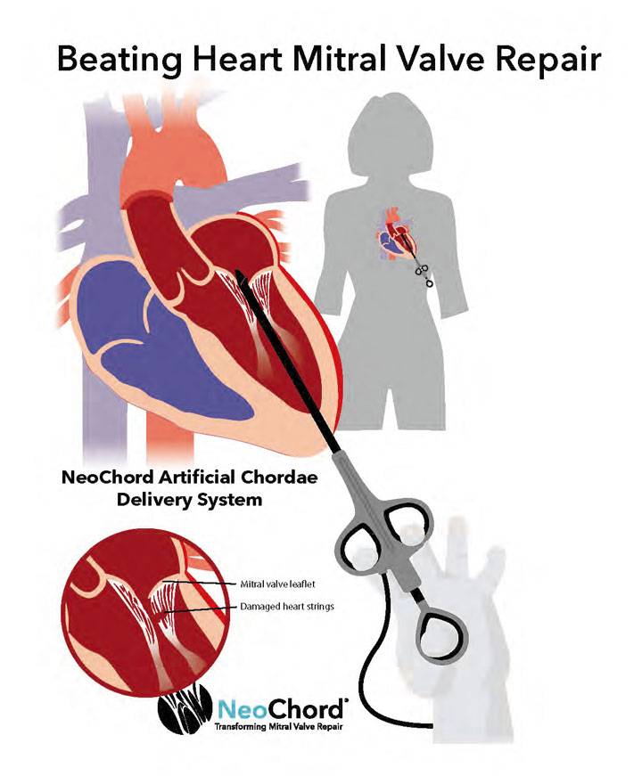 心拍動下僧帽弁形成術（NeoChord®） - ニューハート・ワタナベ国際病院