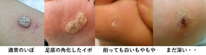 いぼ治療｜大田区大森の大木皮膚科【難治性ウイルス性疣贅にお悩みなら】