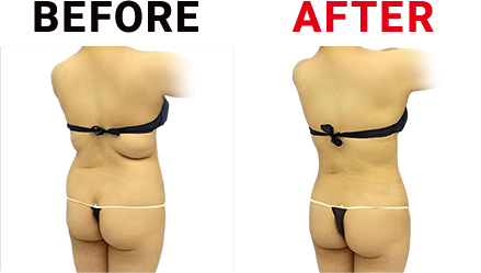 業務用脂肪冷却痩身機フリーズドエッジ｜MRO