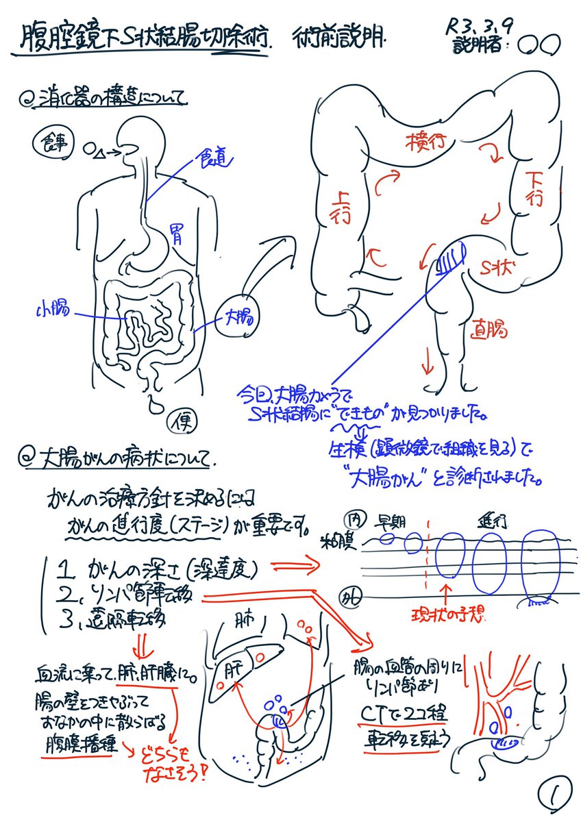 例の手術説明、腹腔鏡下S状結腸切除術で書いてみました。 必ず説明して