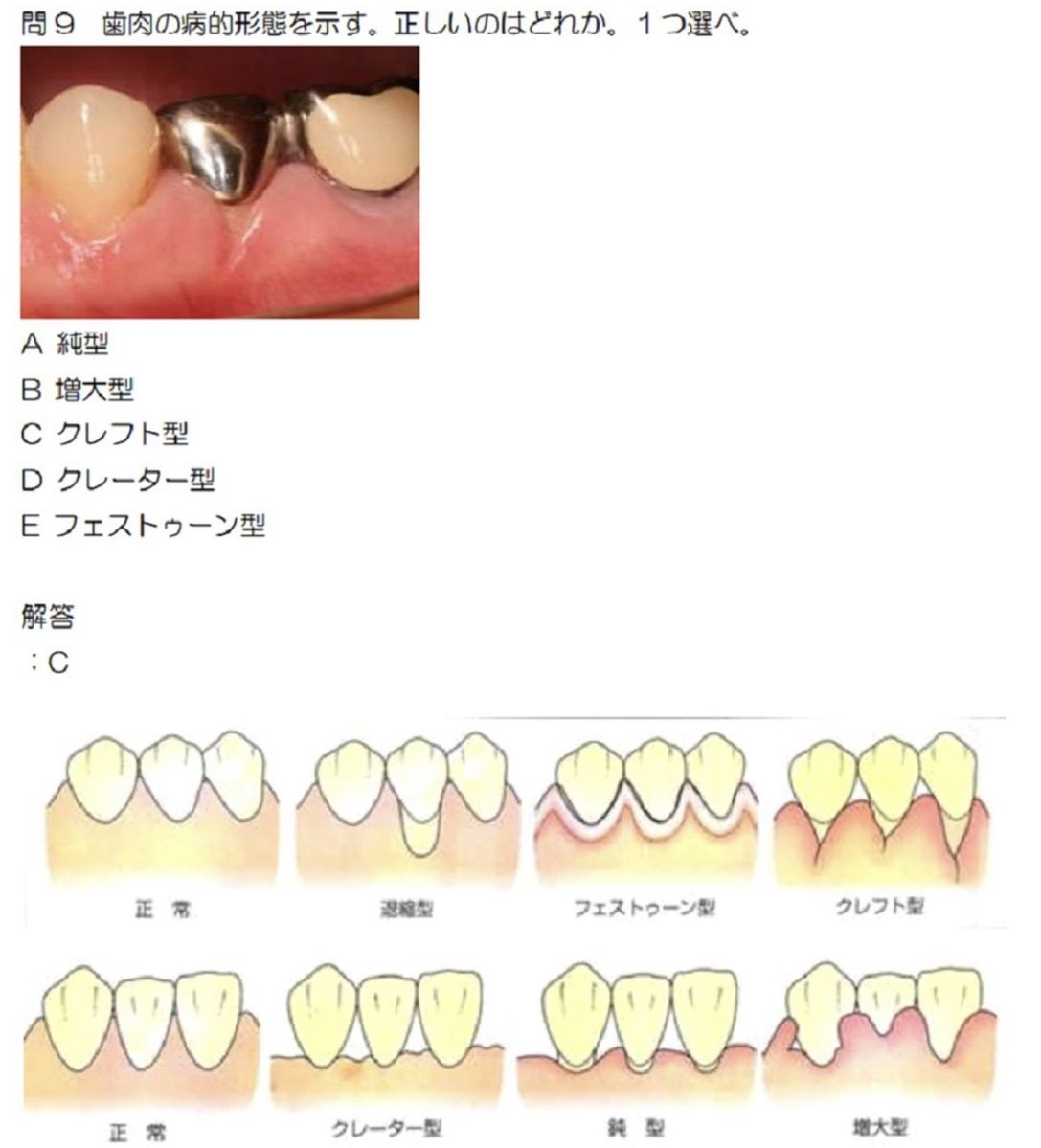 ✔️歯肉の病的形態について