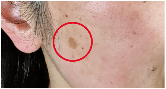 低周波でシミを内側から薄くする、話題のメニュー！【シミデトックス