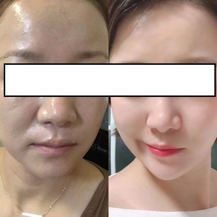 ルネセル化粧品 ＜ダイヤモンドピール+11種類の基礎化粧品＞-ルネセル