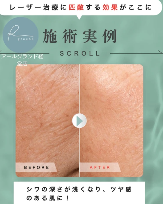 水光肌ピール✨解禁】 | Instagram | 東京都経堂のエステなら結果重視