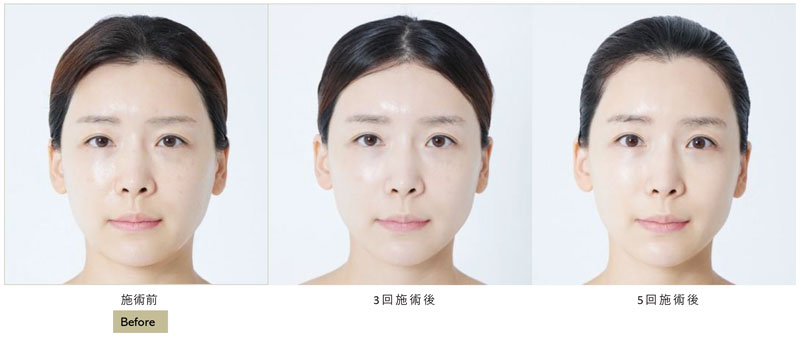 エクソヒーラー「フィルコアSB」｜南越谷病院 皮膚科・美容皮膚科