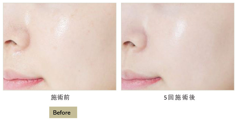 エクソヒーラー「フィルコアSB」｜南越谷病院 皮膚科・美容皮膚科