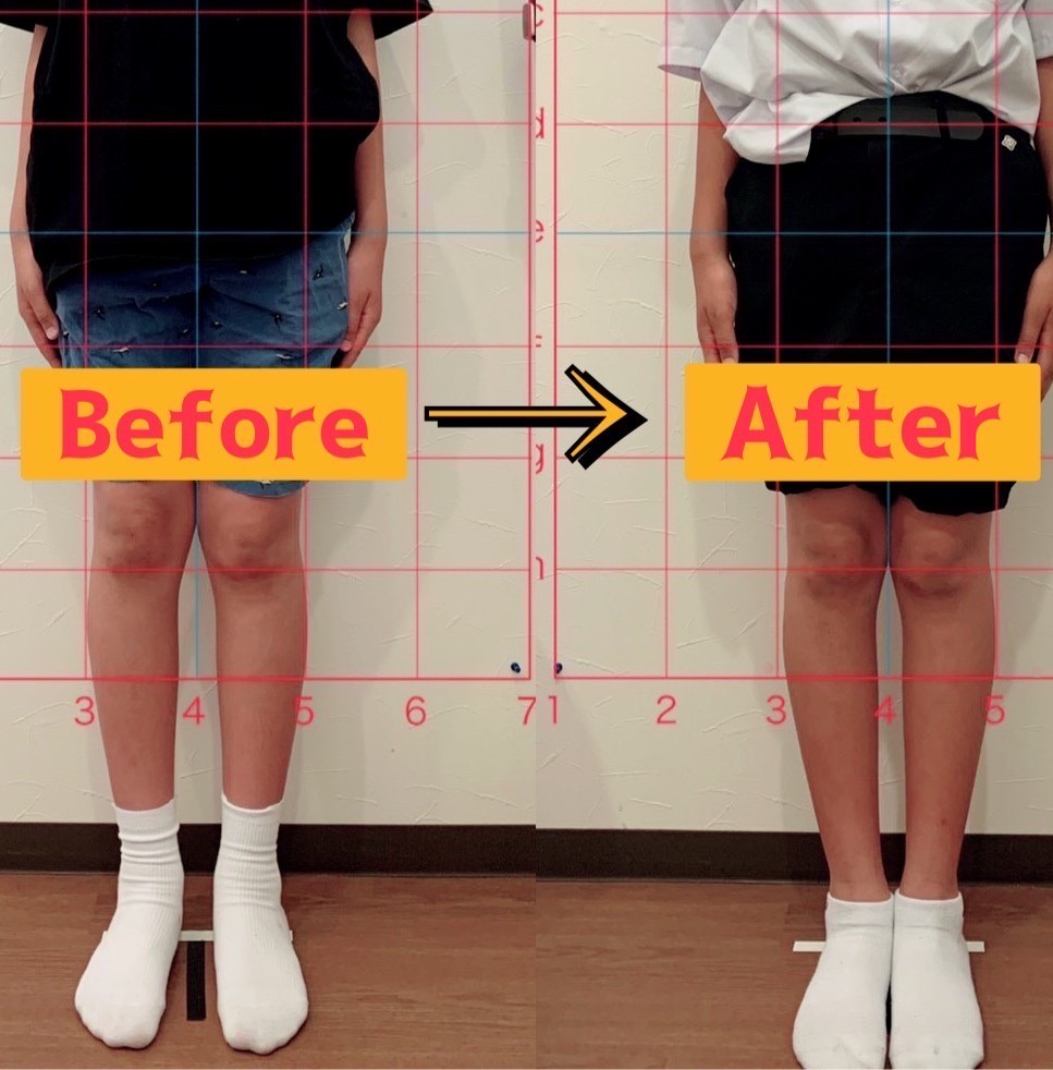 まさかX脚が治るとは！！スタイレックスすごっ！！ | 未来はりきゅう整骨院