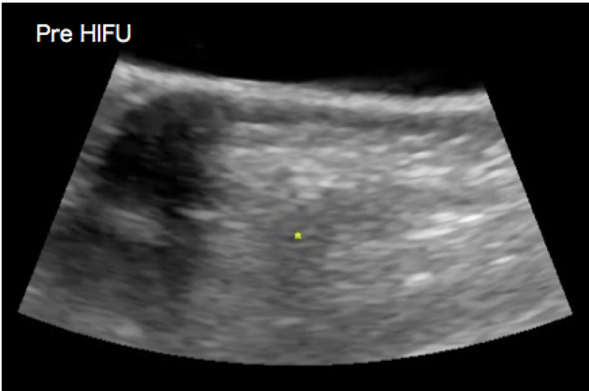 Pre-HIFU.png