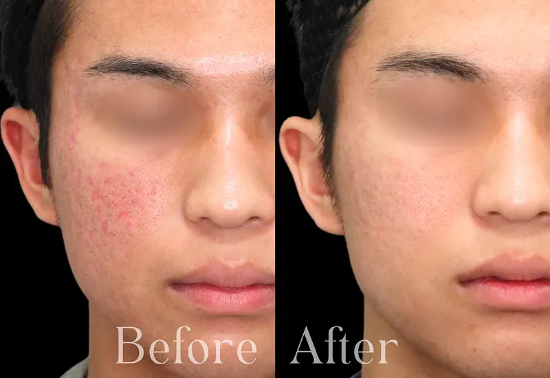 キュアジェット針を使わないクレーター治療 | セレクトクリニック