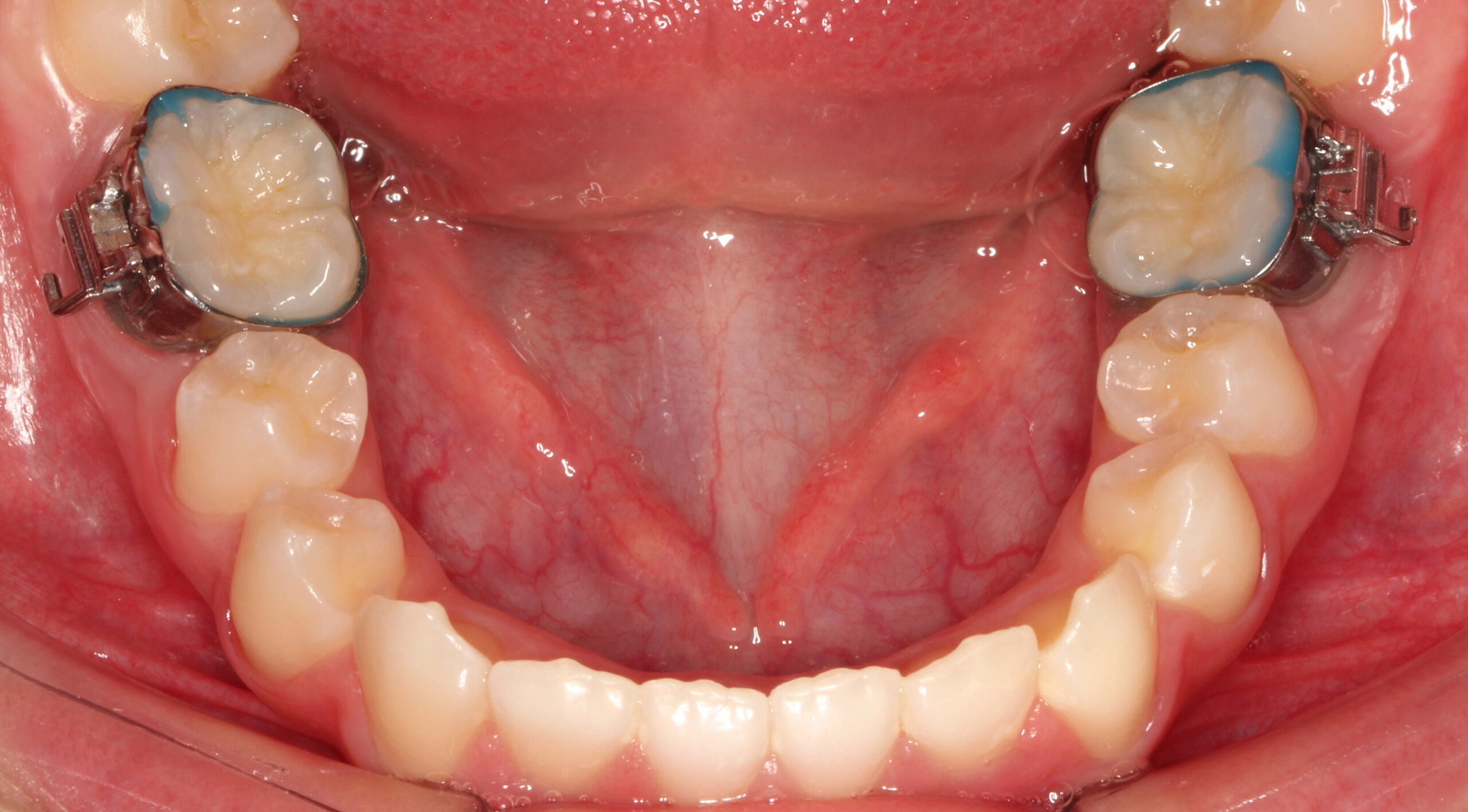 歯列矯正で使うバンド】なんのために？いつまで使うの？【大宮駅2分