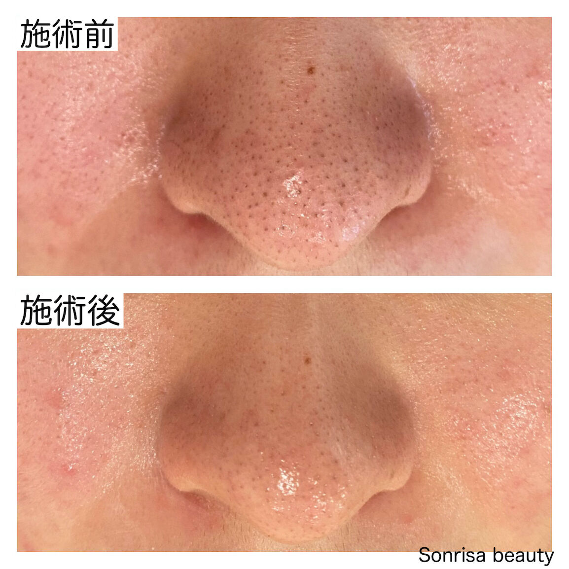 フェイシャル・ハーブピーリング 剥離ありと剥離なしの違いは