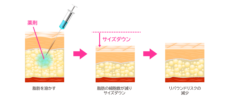 カベリン（脂肪溶解注射） - セントローズクリニック