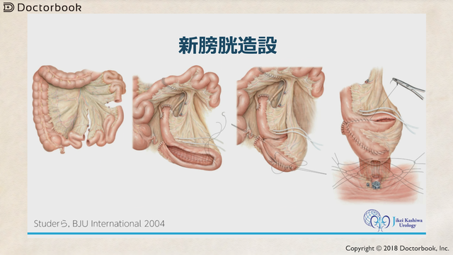 医師出演】膀胱がんの治療における膀胱全摘術と尿路変向術の2つの方法